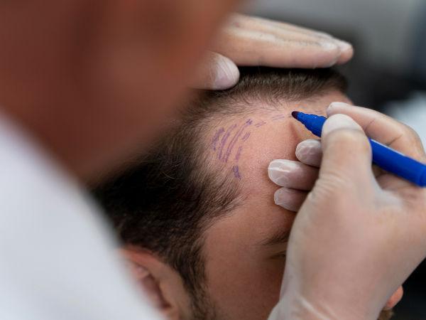 A New You With Fue Hair Transplant