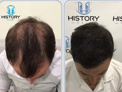 Safir Saç Ekimi Nedir? Avantajları ve Uygulama Süreci