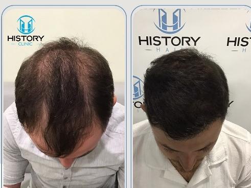 What Is Sapphire Hair Transplant? Benefits and Procedure Explained