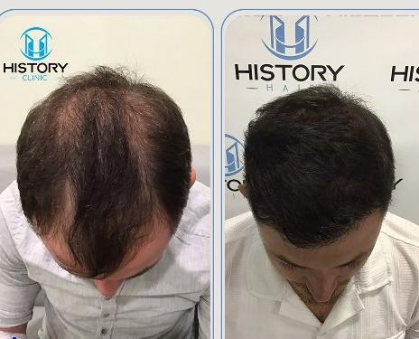 What Is Sapphire Hair Transplant? Benefits and Procedure Explained