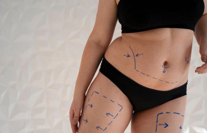Liposuction